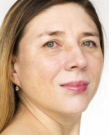 Starnutie pleti a pigmentové škvrny možno riešIť