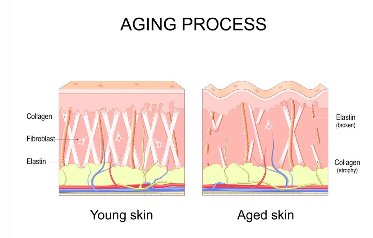Starnutie pleti a úbytok kolagénu